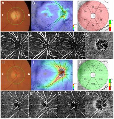 Cognitive Dysfunctions in Glaucoma: An Overview of Morpho-Functional Mechanisms and the Impact on Higher-Order Visual Function